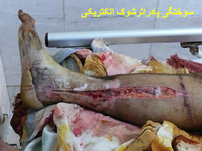 سوختگی پا در اثر عبور جریان الکتریکی