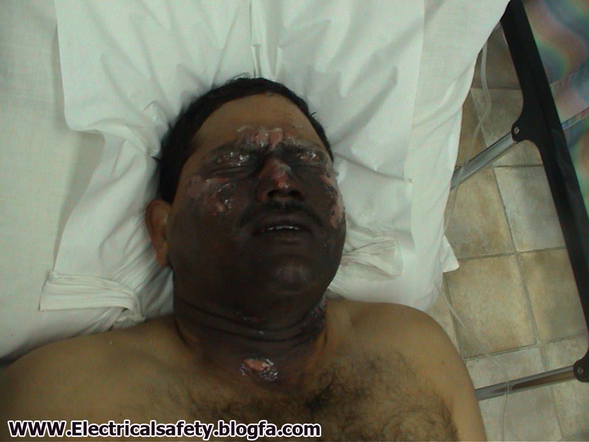سوختگی ناشی از قوس الکتریکی . بدیهی است استفاده از ماسک حفاظ صورت از بروز چنین آسیبهایی به صورت و بالاخص چشمها جلوگیری میکند .  