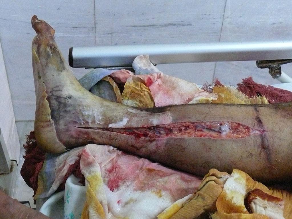 عبور جریان بسیار بالای برق و فروپاشی پای برقکار بدلیل عدم استفاده از کفش ایمنی عایق برق . 